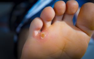Why Do Corns Develop?
