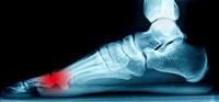 What Part of the Foot Does Morton’s Neuroma Affect?