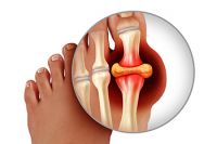 Gout and Foods