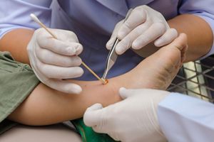 Cleaning Foot Wounds